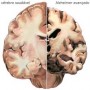 alzheimer
