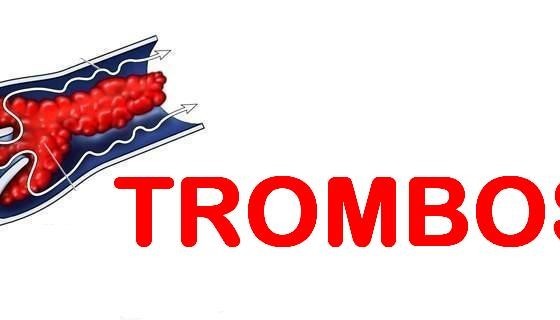 trombose1
